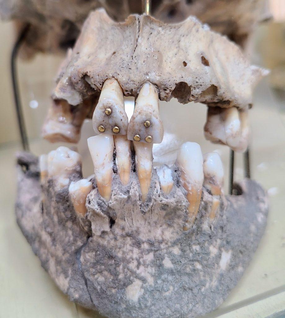 gold dental implants, Museo de las Culturas Aborigenes, Cuenca, Ecuador